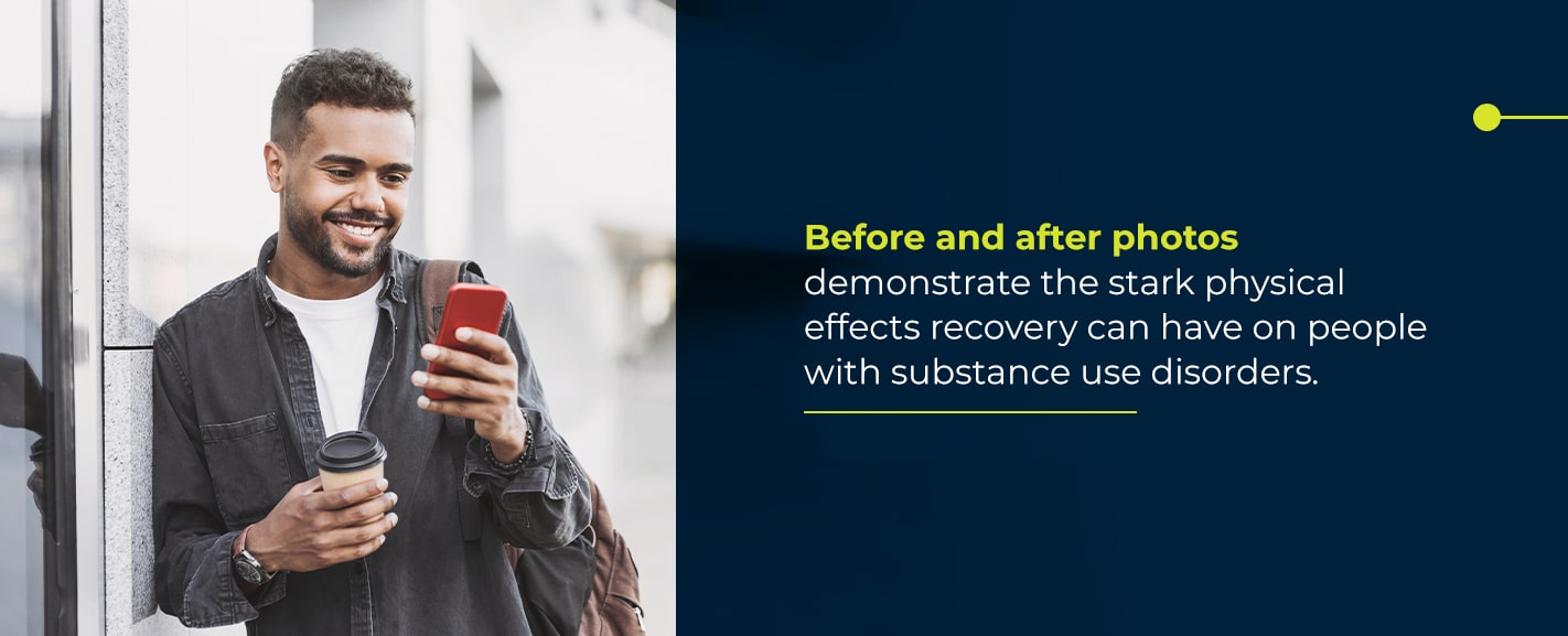 Before and after photos demonstrate the stark physical effects recovery can have on people with substance use disorders